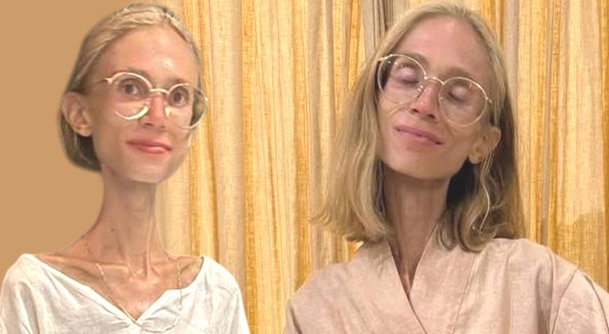 22 kiloya kadar düştü! Sosyal medya fenomeni hayatını kaybetti