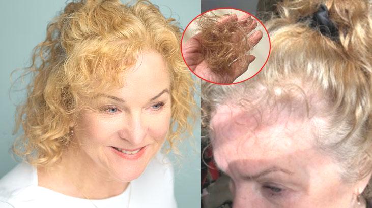 12 kilo verdi ama saçları avuç avuç döküldü! Kökleri küçülten tehlike: ‘Etkisi uzun’