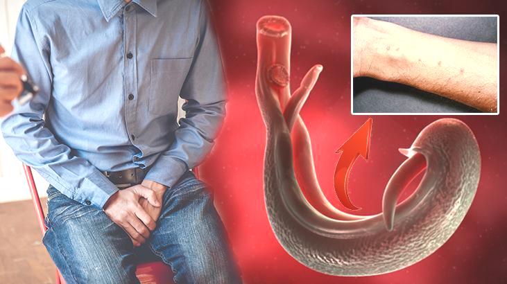 Yeni küresel tehdit: Melez şiştozomiyaz! Cinsel organlara yerleşip kısırlığa yol açıyor