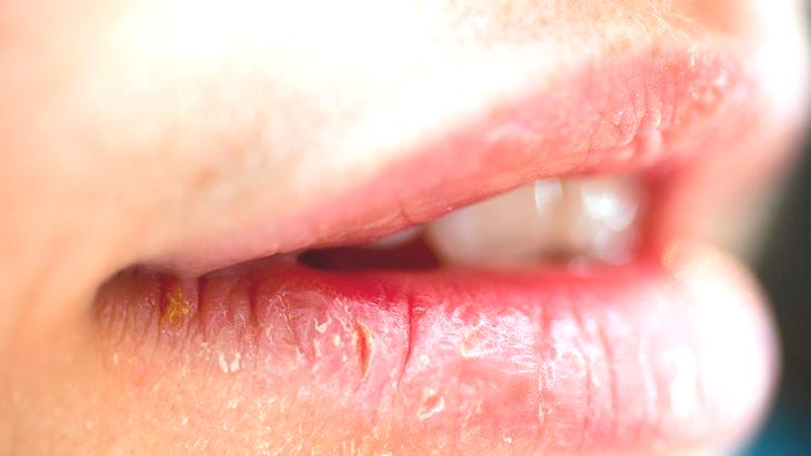 Ağız ve dudaktaki yaraları hafife almayın! Ciddi hastalıkların belirtisi olabilir