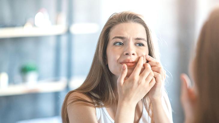 Akneyle mücadelede doğru adım! Erken tedavi iz bırakmıyor