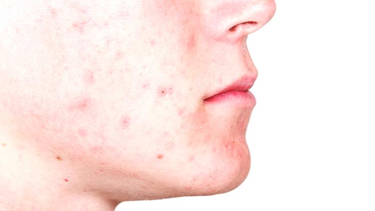 Gece bantla sabah sonuç inanılmaz! Sivilcelere 1 gecede doğal çözüm