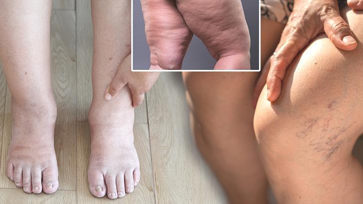 Kilo değil hastalık! Bu hatalar bacaklarda dolaşımı bozuyor
