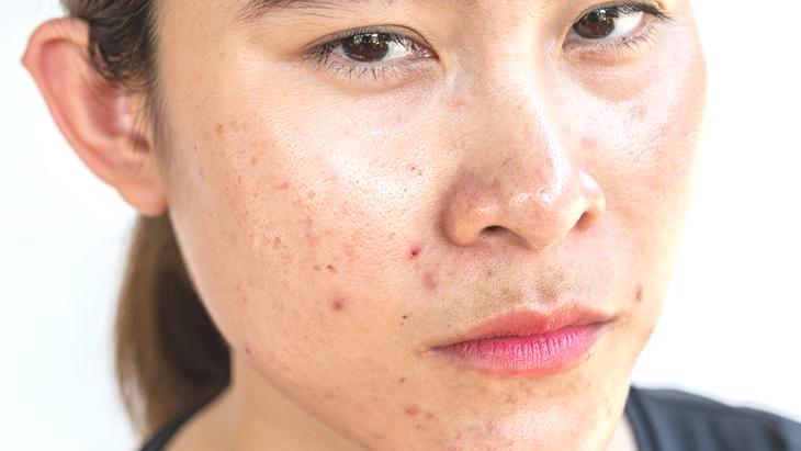 Pürüzsüz bir cilt için hormonal denge! Uzmanından tavsiyeler