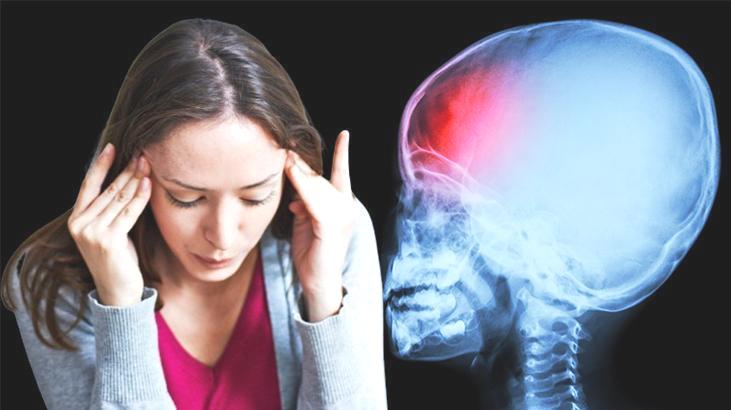 Sıradan sandı, hayatı değişti! Baş ağrısı beyin kanaması çıktı