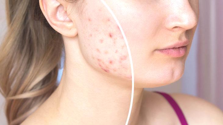 Yetişkinlik aknesinin çözümü başka! Sivilcelerden kurtulmak için özel uygulama